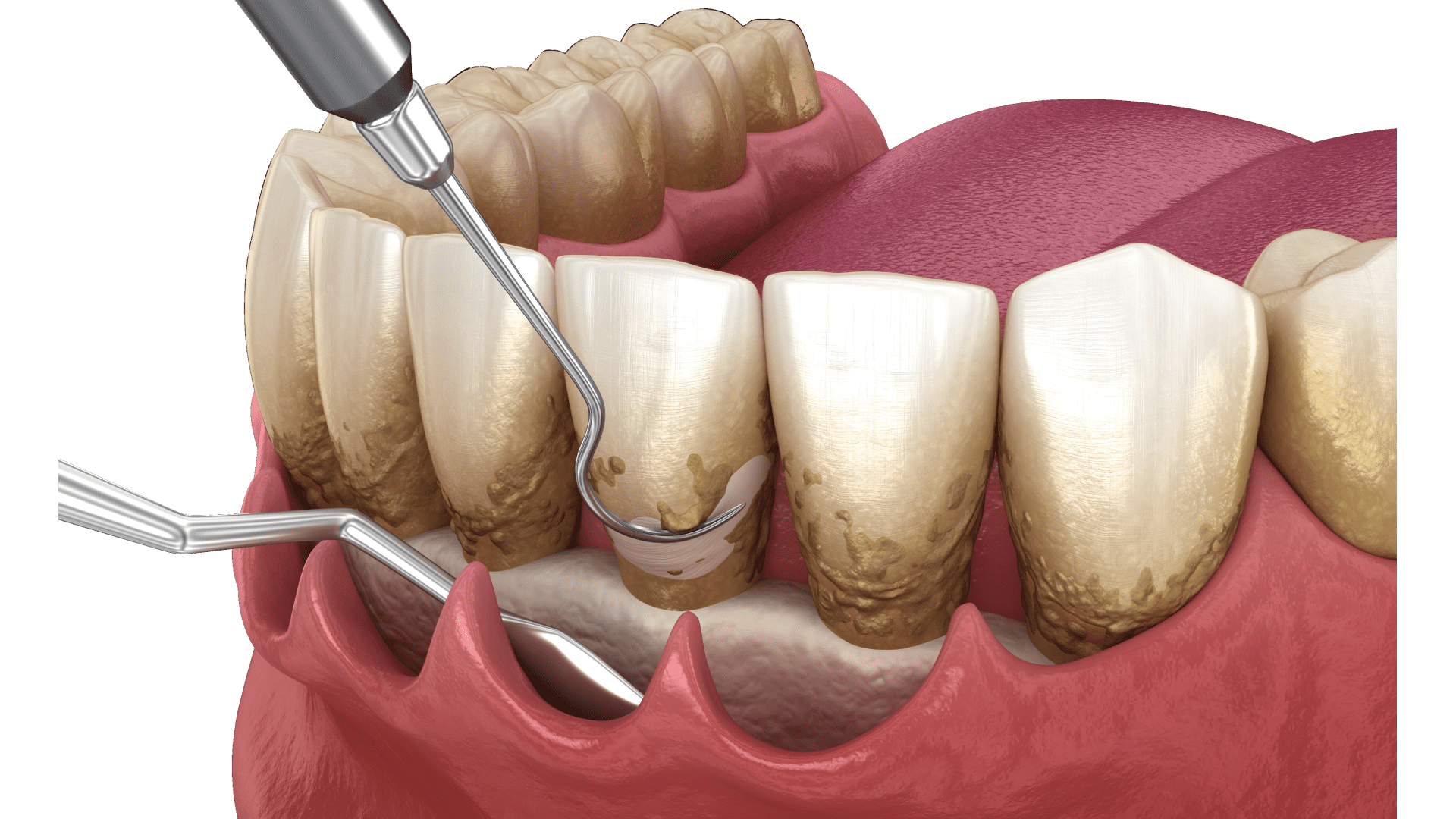 Видалення зубного каменю 2 Як впливає тип зубного каменю на вибір методу видалення