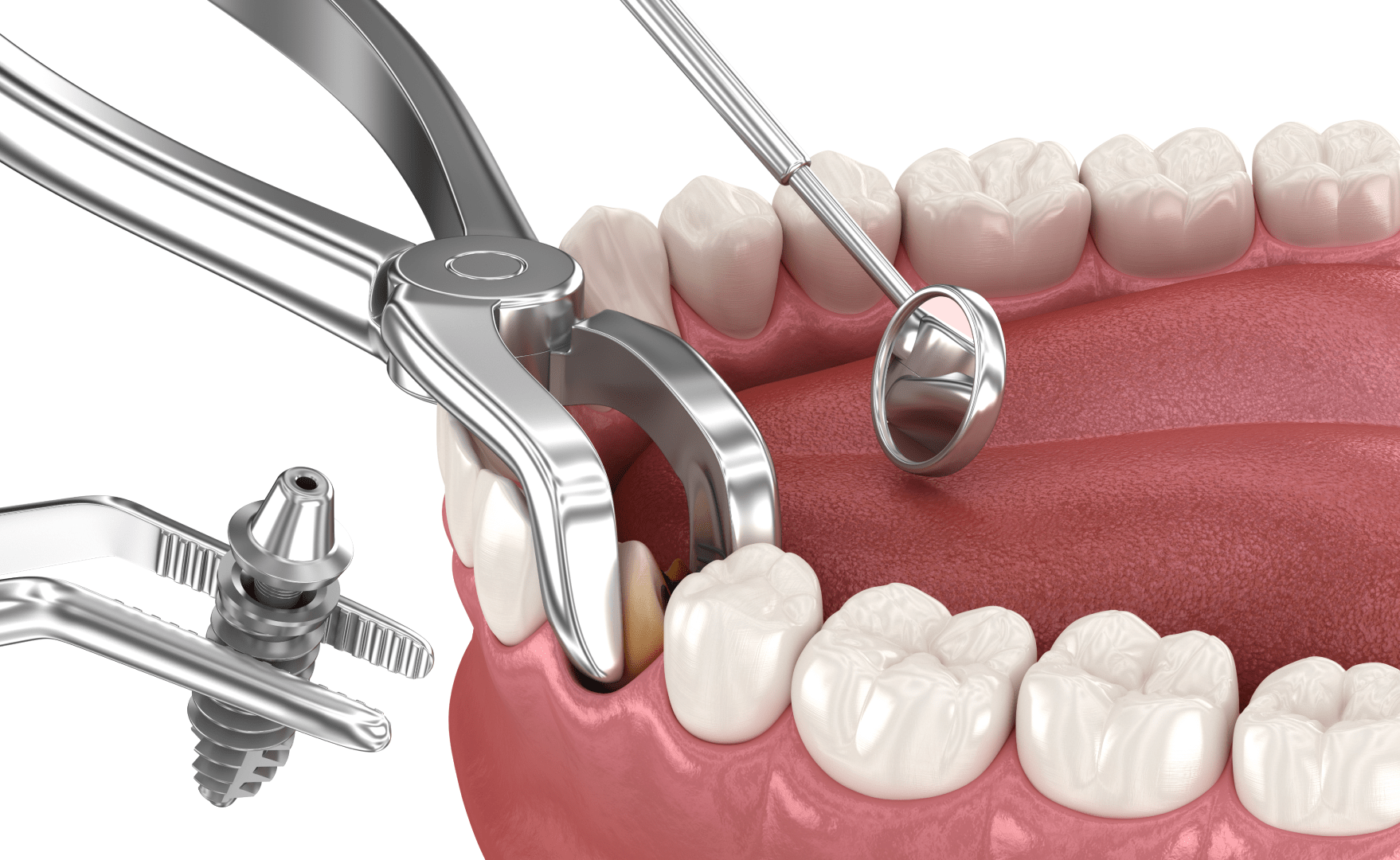 Ціна імпланту зуба в Києві