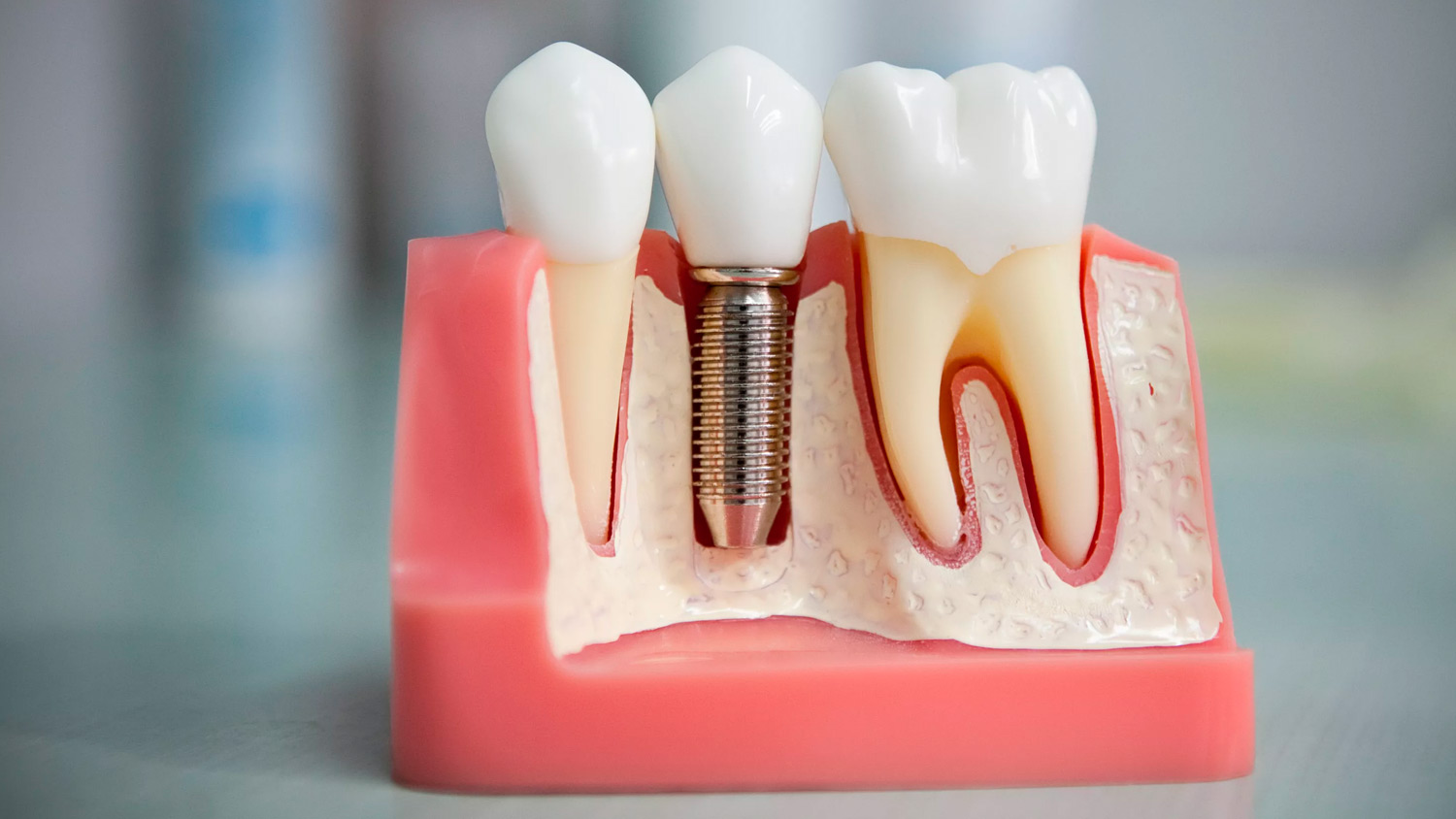 Імплантація зубів (Київ): недорого та з гарантією 2 Імплантація зубів: ціни в Києві, дешево та якісно