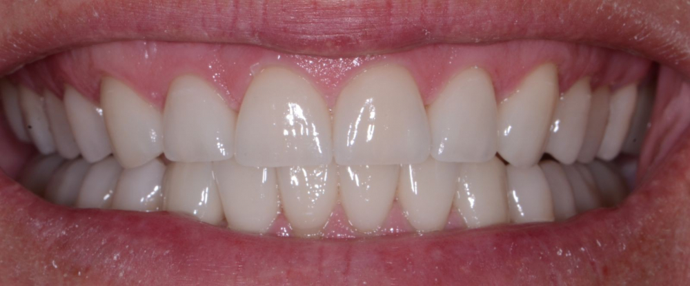 Ортогнатичний прикус 1 Правильний прикус зубів у дорослих: який він