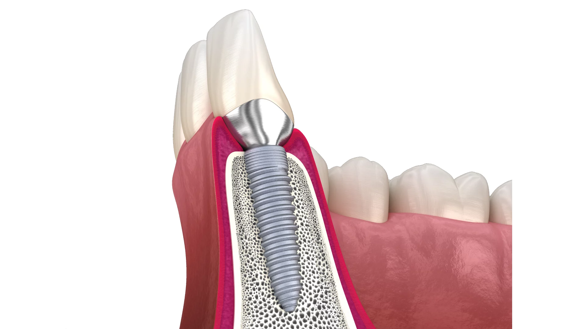 Чи можна встановлювати імпланти в разі остеопорозу