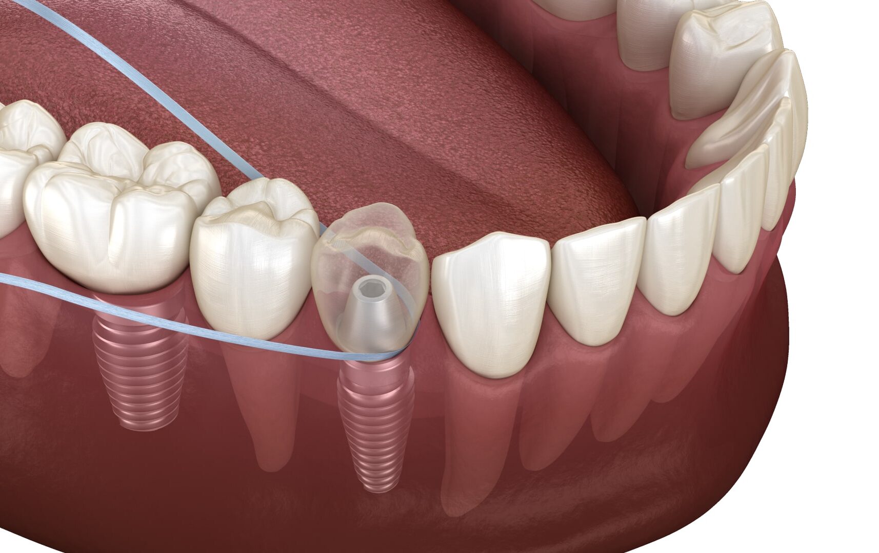 Чи можна встановити зубний імплант при остеопорозі?