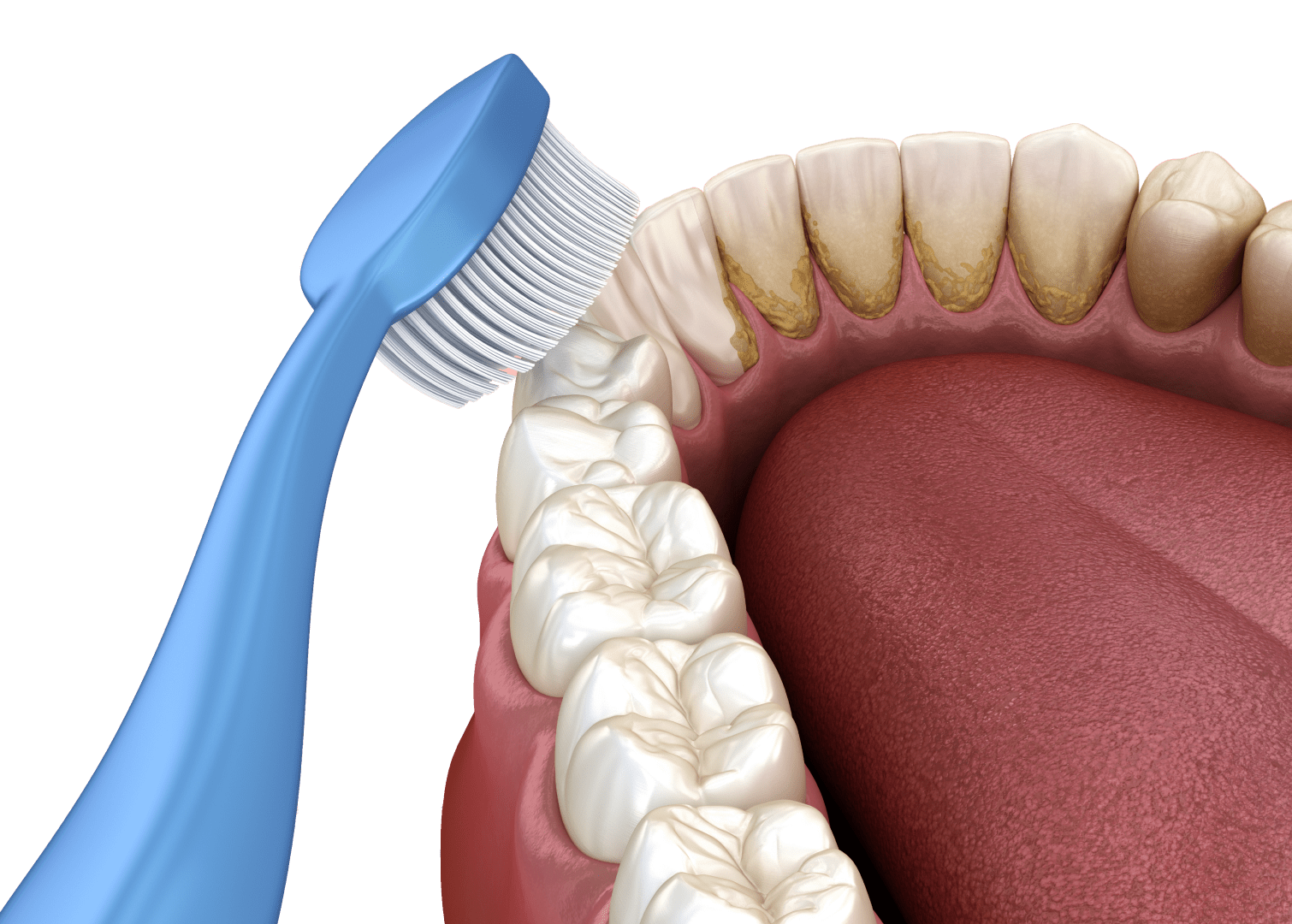 Пломбування зубів: у яких випадках та як проводиться