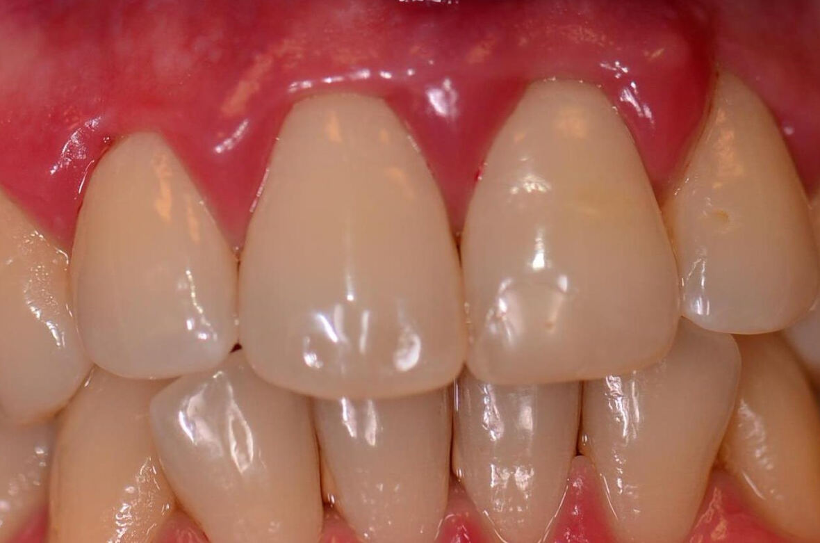 Запалені ясна: що робити