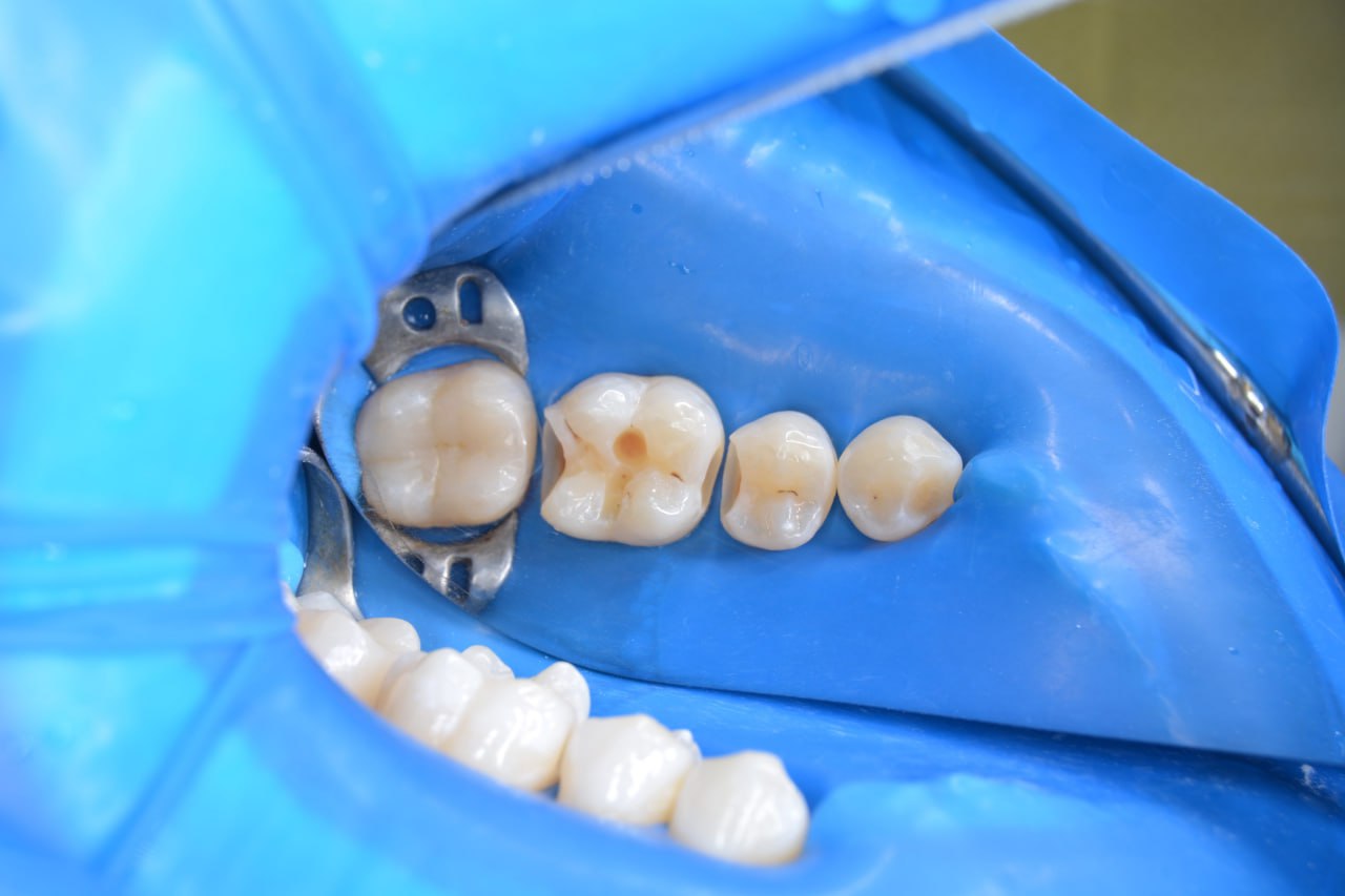 Пломбування зубів: у яких випадках та як проводиться