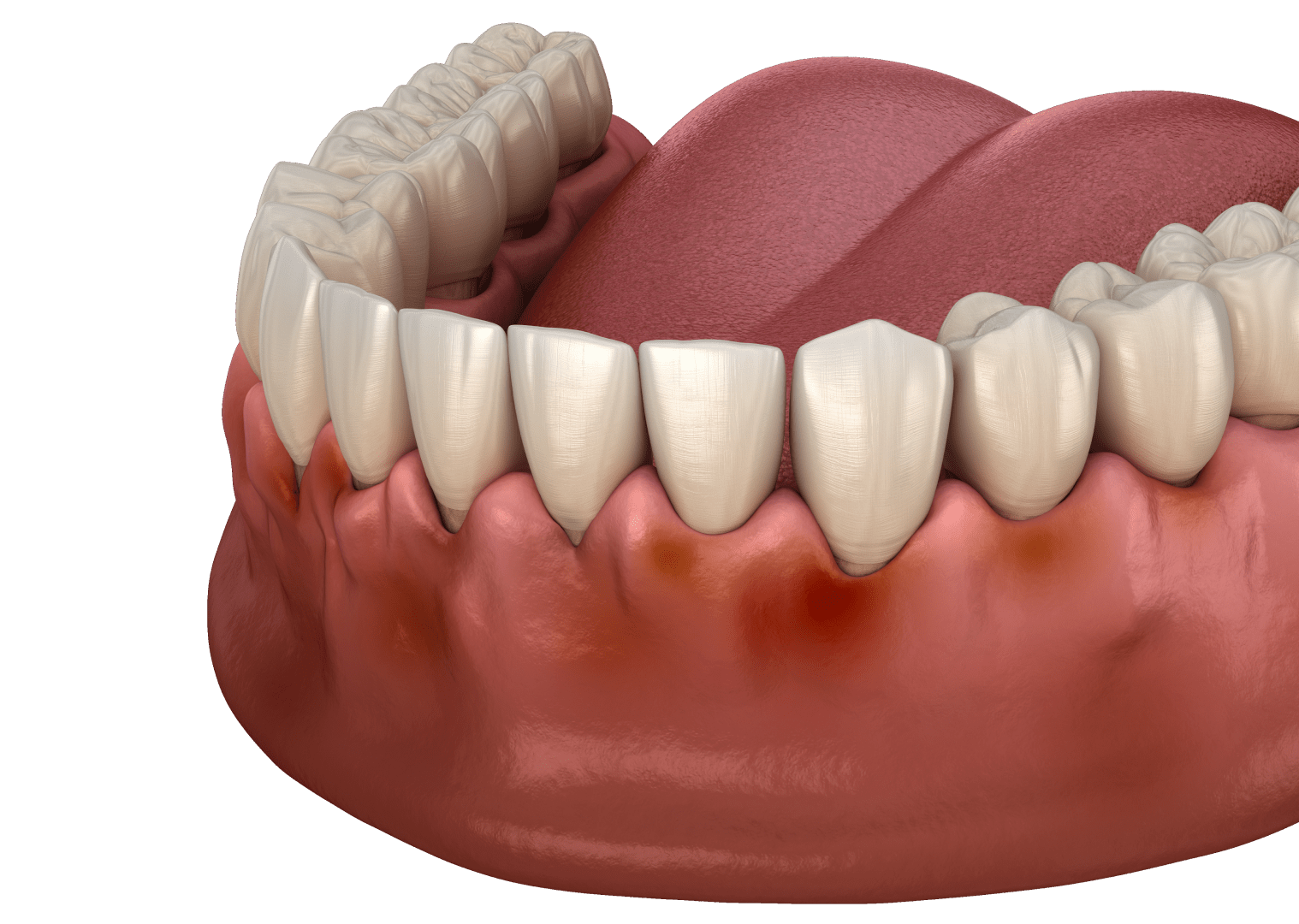 Запалення ясен: чим лікувати