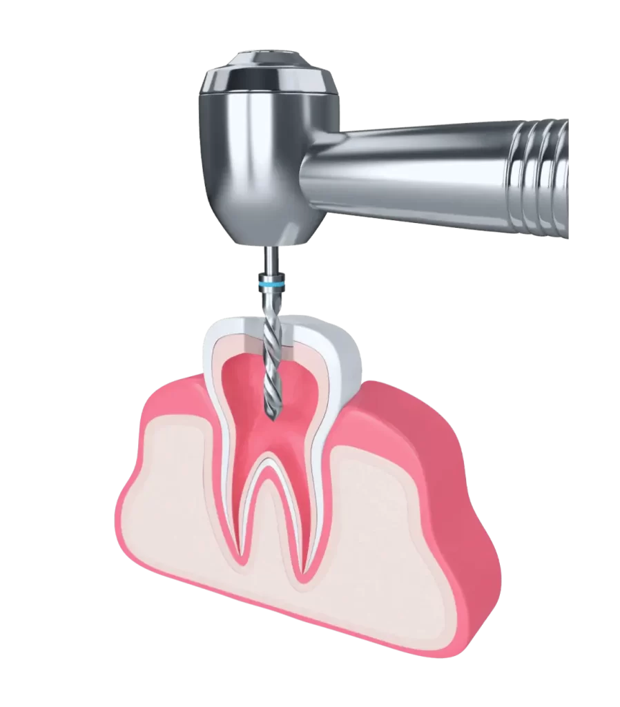 Що передбачає обтурація кореневих каналів