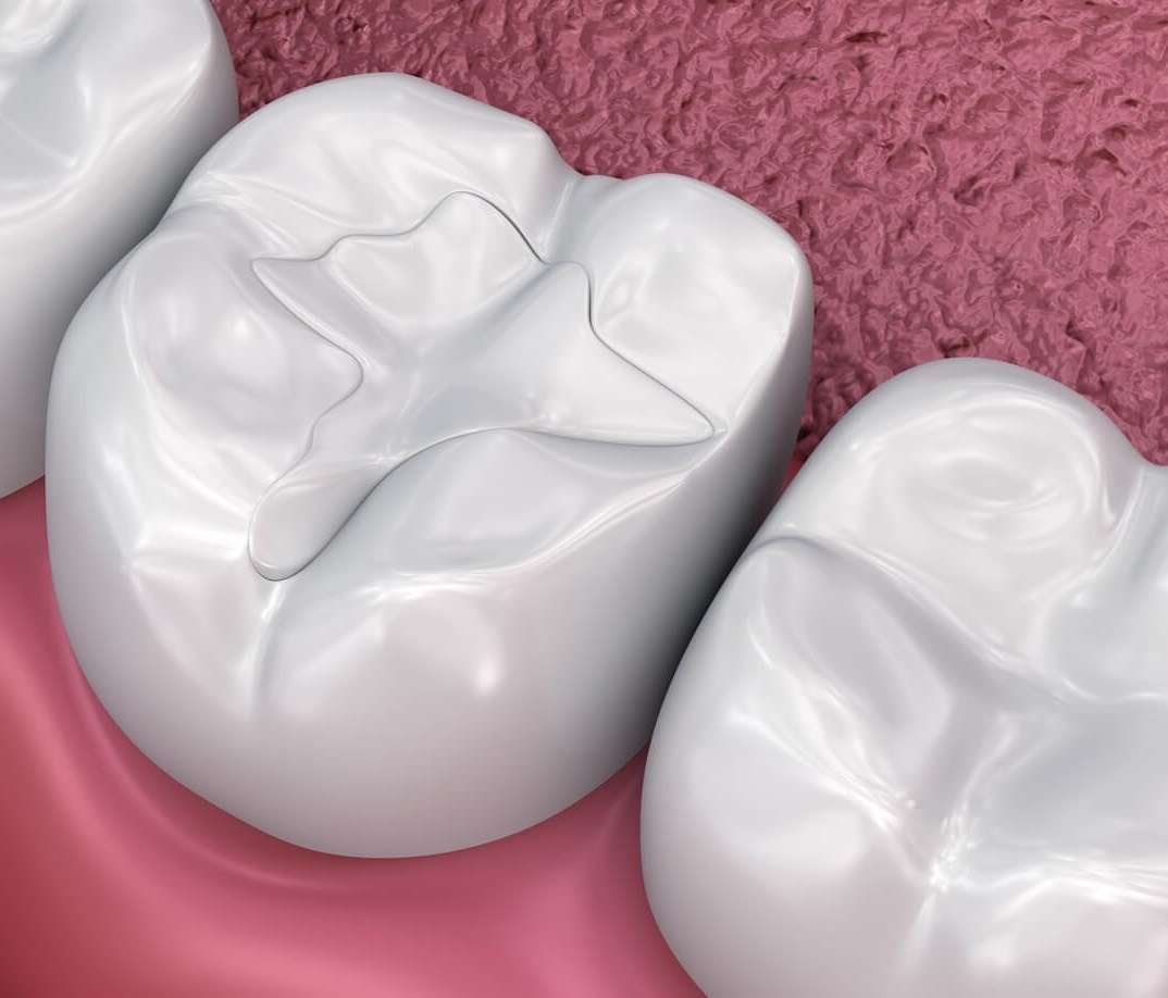 Пломбування зубів: у яких випадках та як проводиться