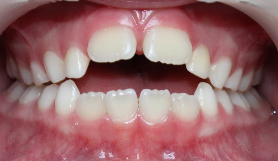 Відкритий прикус 2 Причини розвитку відкритого прикусу