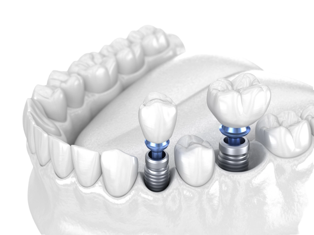 Встановлення абатмента 3 Особливості встановлення абатмента