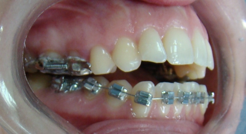 Відкритий прикус 3 Діагностика та лікування відкритого прикусу