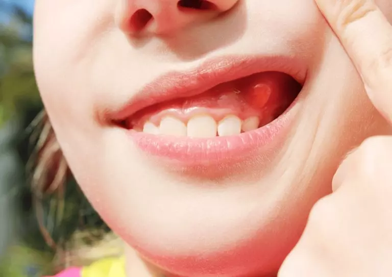 Симптоми екзостозу: що має насторожити