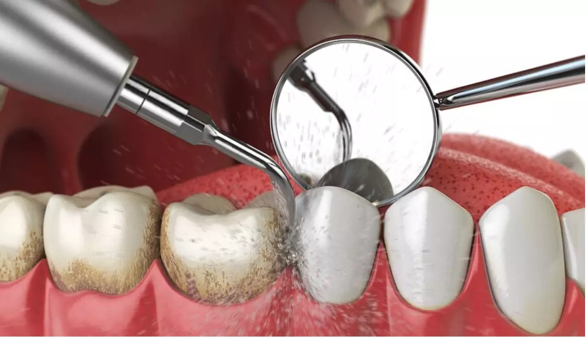 Профілактика почорніння зубів