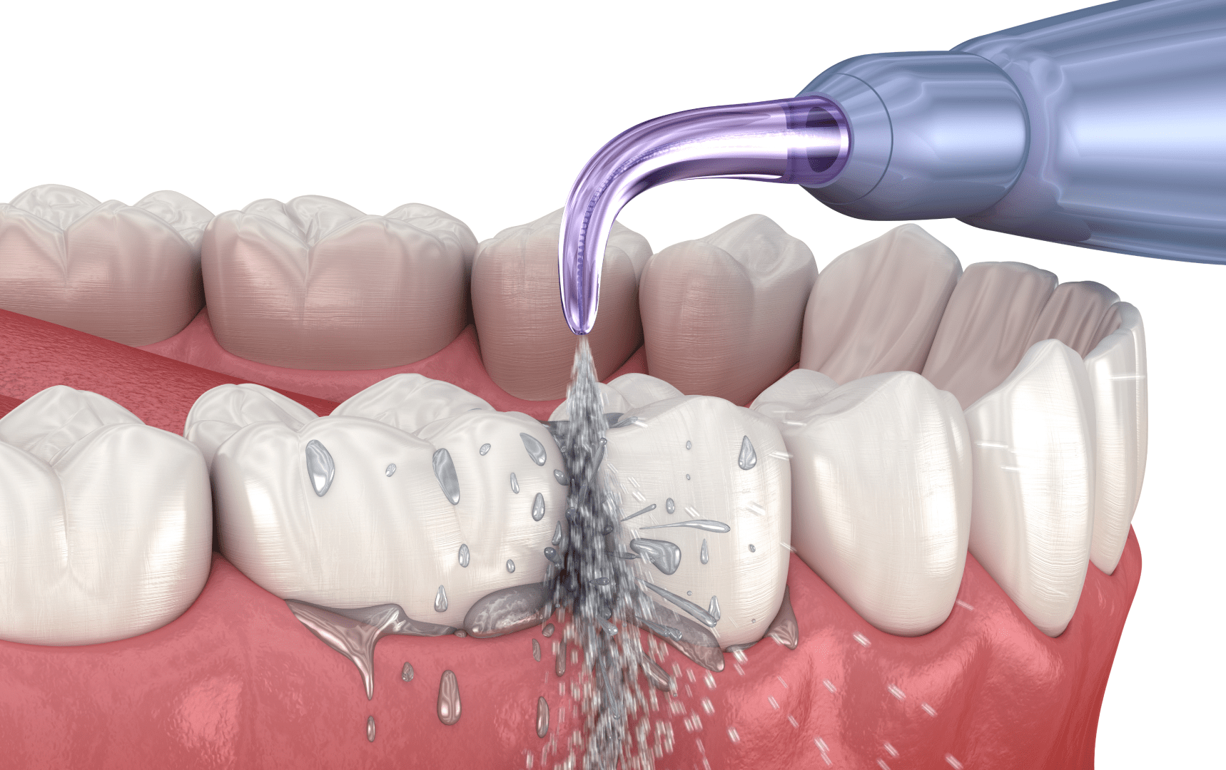 Яких засобів та інструментів вимагає домашній догляд після імплантації