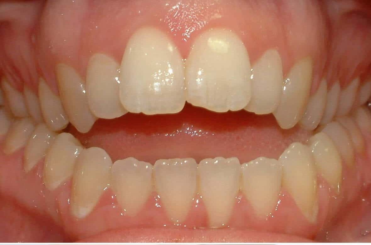 Відкритий прикус 1 Відкритий прикус: особливості та вплив на здоров’я