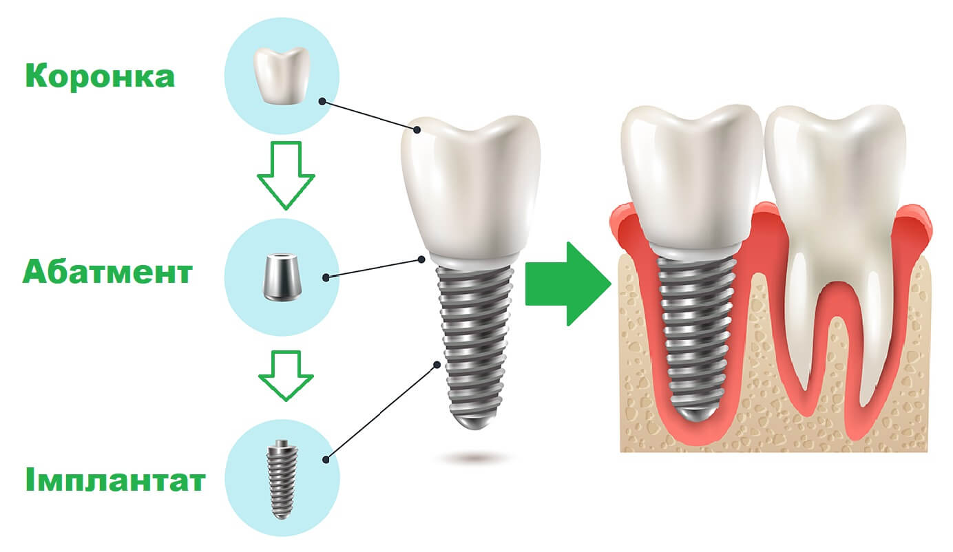 Протезування всього ряду