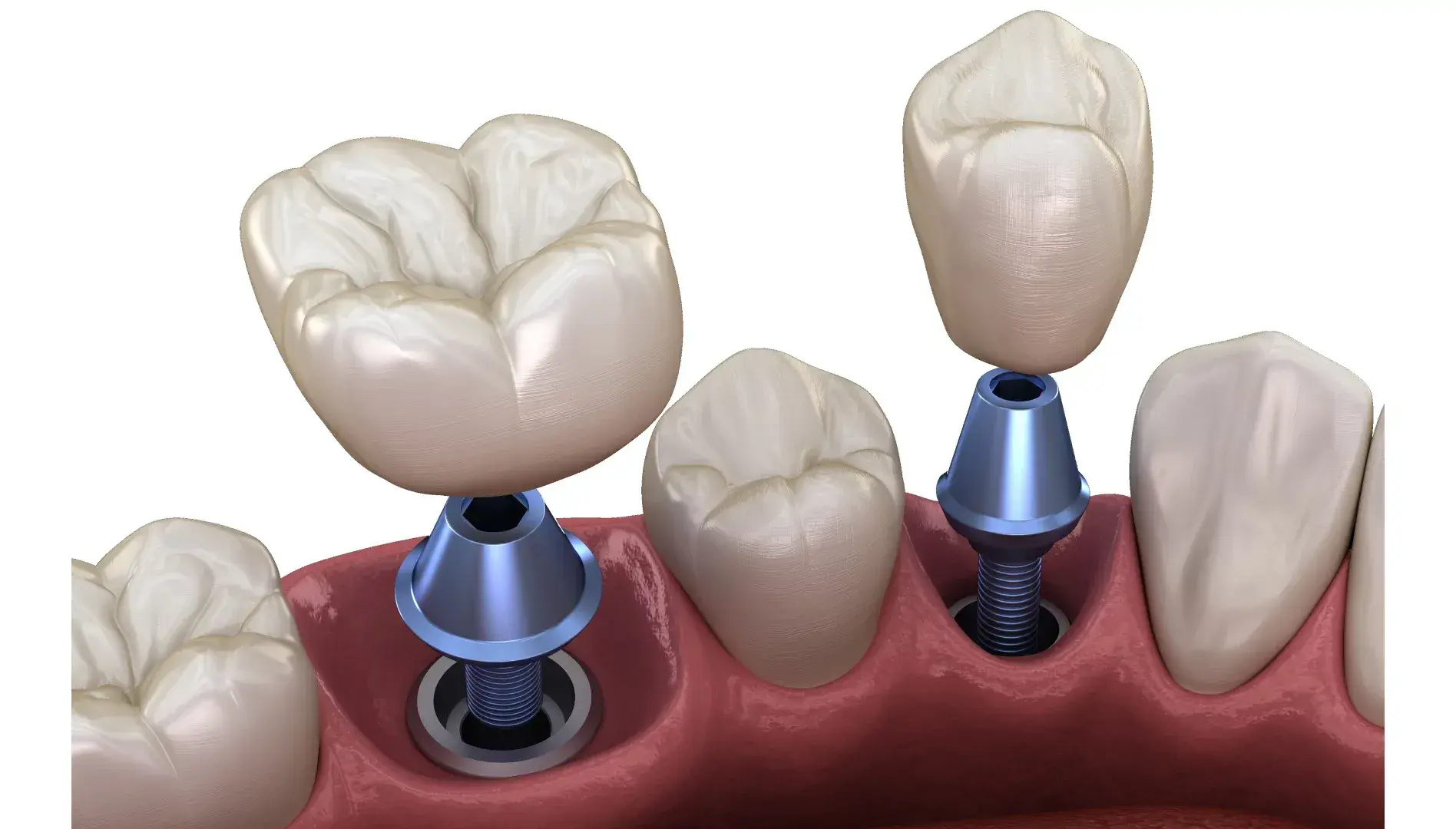Встановлення абатмента 2 Встановлення абатмента: особливості конструкції
