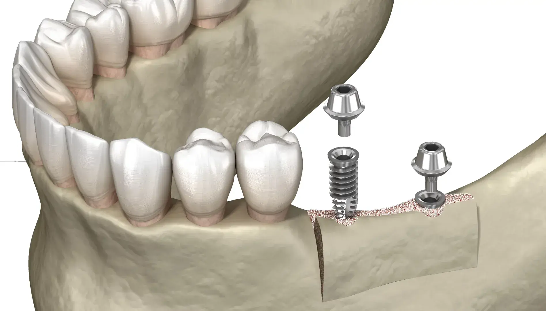 Встановлення абатмента 1 Абатмент як ключовий елемент імплантації