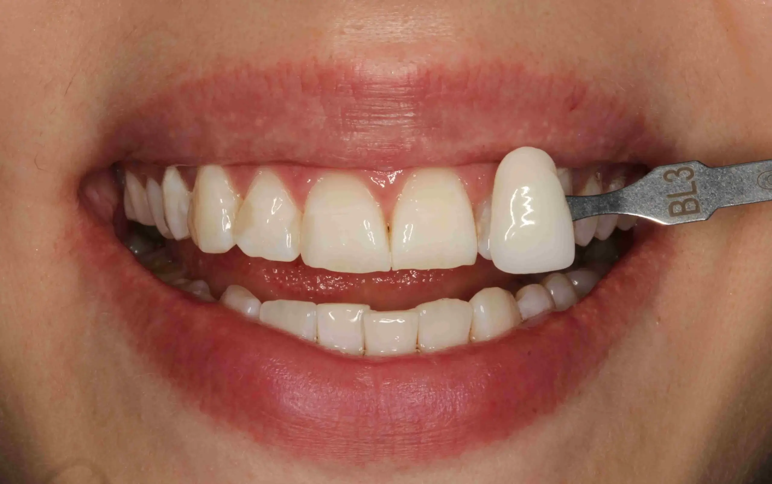 Скільки коштує відбілити зуби: відбілювання зубів у Києві в UkrDentClub 1 Скільки коштує відбілювання зубів у Києві