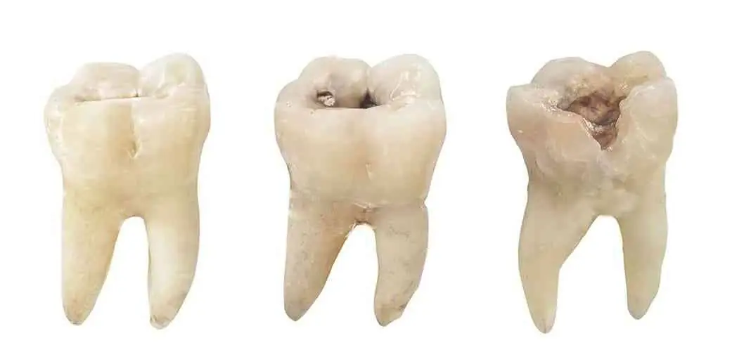 Чому з’являються чорні зуби в дорослих і дітей