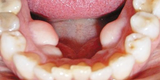 Чому може виникнути екзостоз після видалення зуба