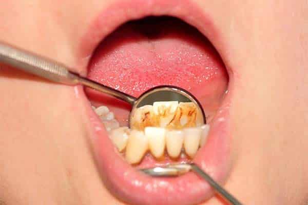 Як куріння впливає на зуби та ясна 2 Як куріння впливає на зуби та ясна