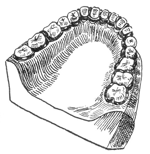 Як виготовляється знімна шина