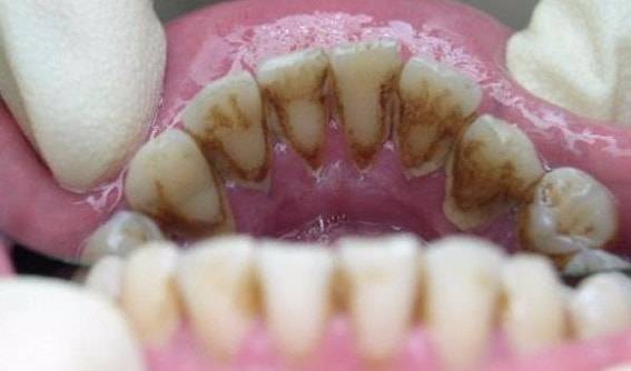 Чому чорніють зуби