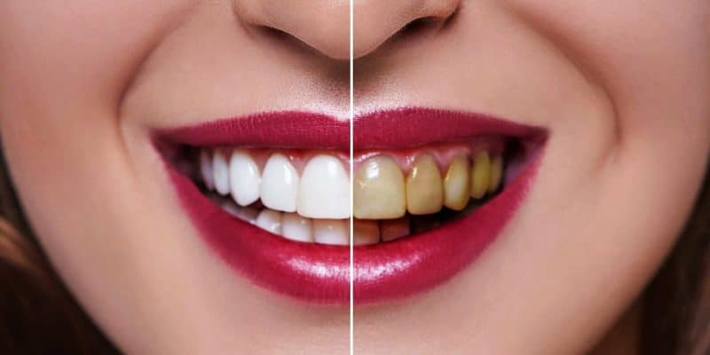 Як куріння впливає на зуби та ясна 3 Рекомендації стоматологів для курця