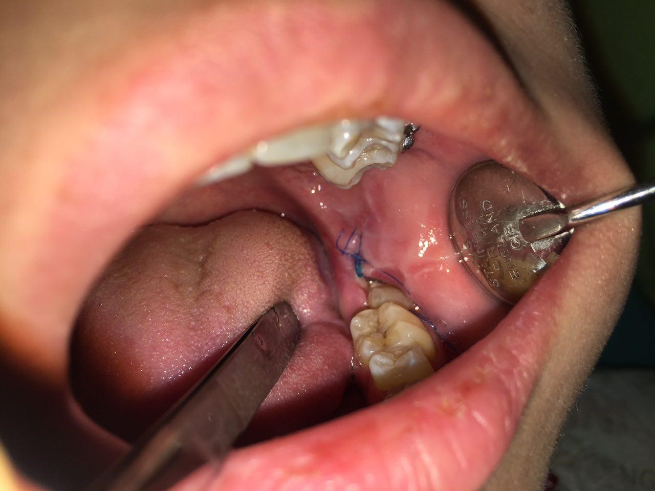 Чому болять ясна біля зуба мудрості 1 Симптоми запалення ясен навколо зуба мудрості